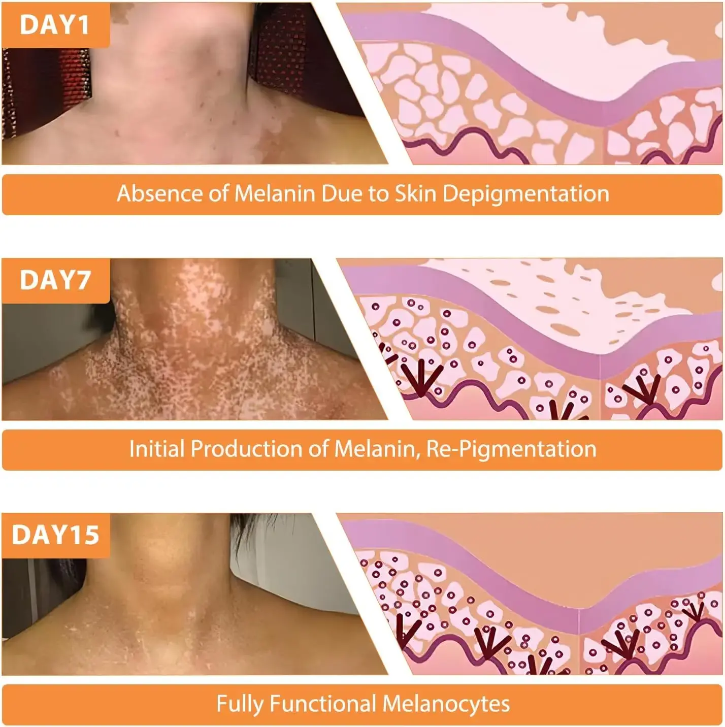 generic-vitigo-bee-venom-treatment-cream-03