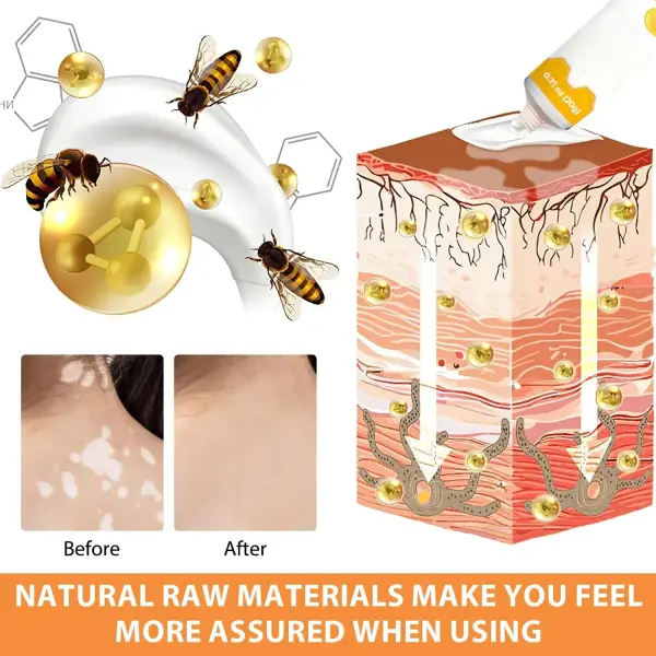 Vitigo Been Venom Treatment Cream For Skin and Rashes