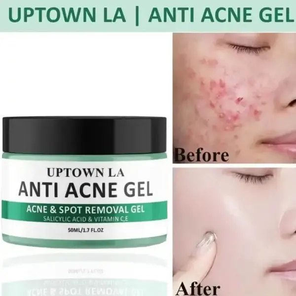 Uptown LA Anti-Acne Gel - 50ML