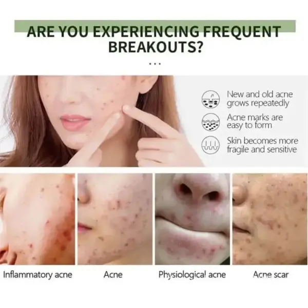 Uptown LA Anti-Acne Gel - 50ML